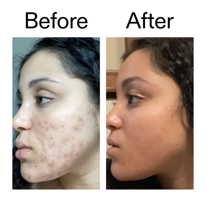 Before and after comparison of a person's face with visible acne on the left, and clearer skin on the right.